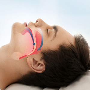 Obstructive sleep apnea